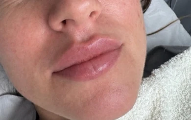 Lip fillers: before and after , after