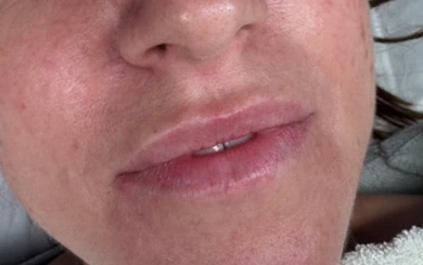 Lip fillers: before and after , before